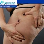 Long term effects of Liposuction