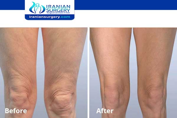 Loose skin after liposuction thighs 1