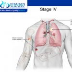 سرطان الرئة المرحلة الرابعة