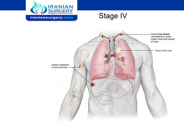 المرحلة الرابعة من سرطان الرئة أعراض المرحلة الرابعة من علاج سرطان الرئة من المرحلة الرابعة من سرطان الرئة