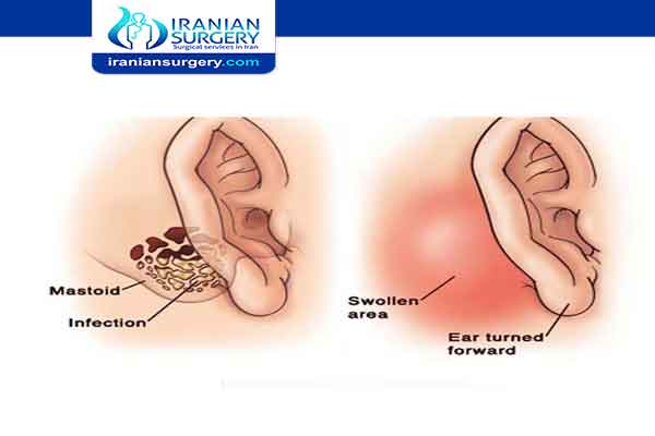Mastoidectomy procedure in Iran