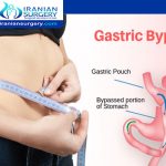 Mini gastric bypass surgery pros and cons
