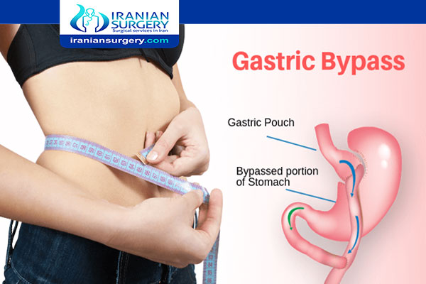 Mini gastric bypass surgery pros and cons