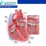 عملیة تغییر صمام القلب المیترالي