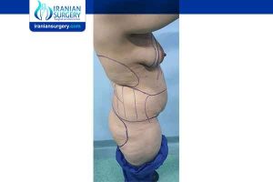 full body liposuction cost