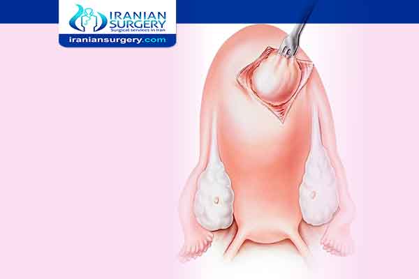 Myomectomy Surgery in Iran