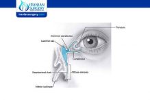 What Is NLDO Of The Eye?|What Are Signs Of Nasolacrimal?|Iranian Surgery