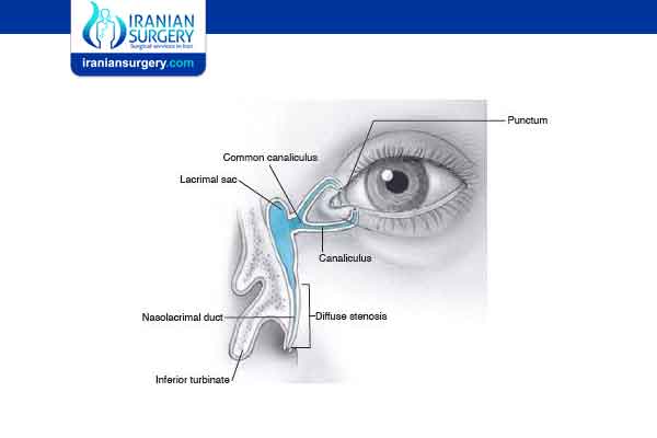 Nasolacrimal duct obstruction (NLDO)