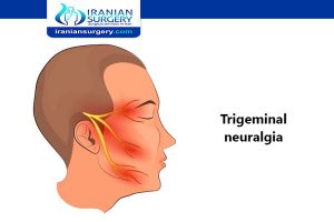 Neuralgia treatment | Neuralgia Types and symptoms | Iranian Surgery