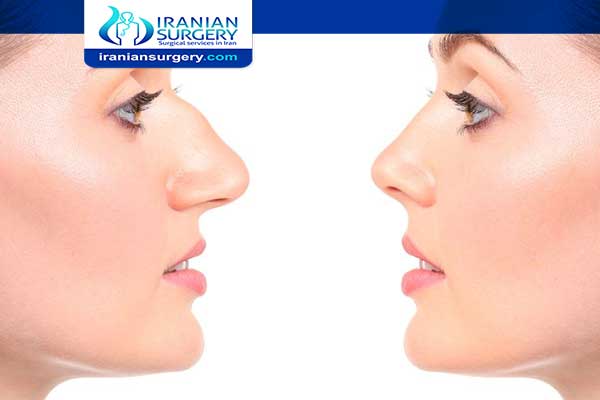 Nose reshaping without surgery