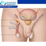 Orchiectomy surgery for prostate cancer