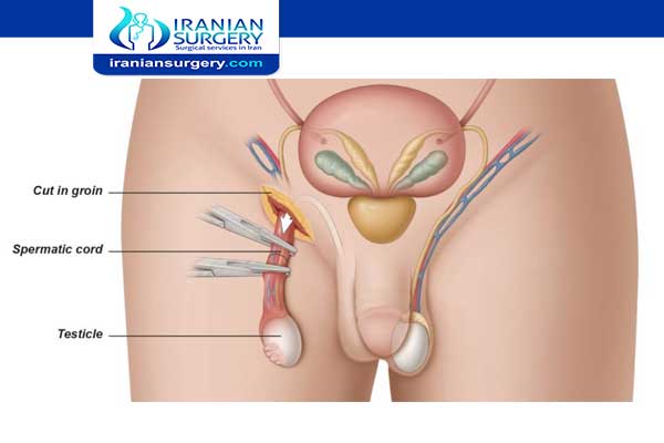 Orchiectomy surgery for prostate cancer