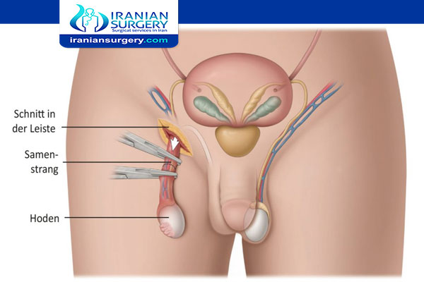 Orchiectomy surgery in Iran
