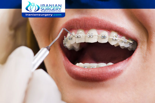 تقويم الاسنان تقويم الاسنان للاطفال تقويم الأسنان قبل وبعد تقويم الاسنان الداخلي