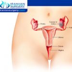 Ovarian Cancer Treatment in Iran