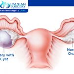 Ovarian Cyst Size Chart