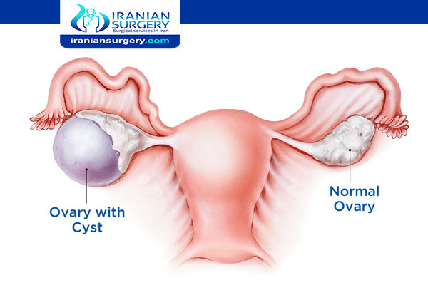 Ovarian cyst size chart