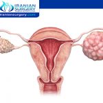 Ovarian cancer stages