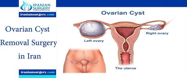 Ovarian Cyst Surgery Cost Iin Iran Ovary Removal Surgery Iranian
