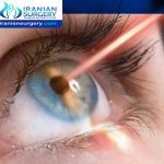 PRK eye surgery in Iran