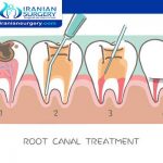 Pain after root canal