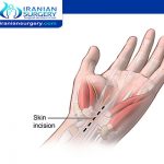 Pain and Other Complications of Carpal Tunnel Surgery