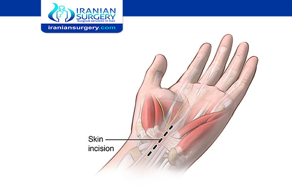 Pain and Other Complications of Carpal Tunnel Surgery