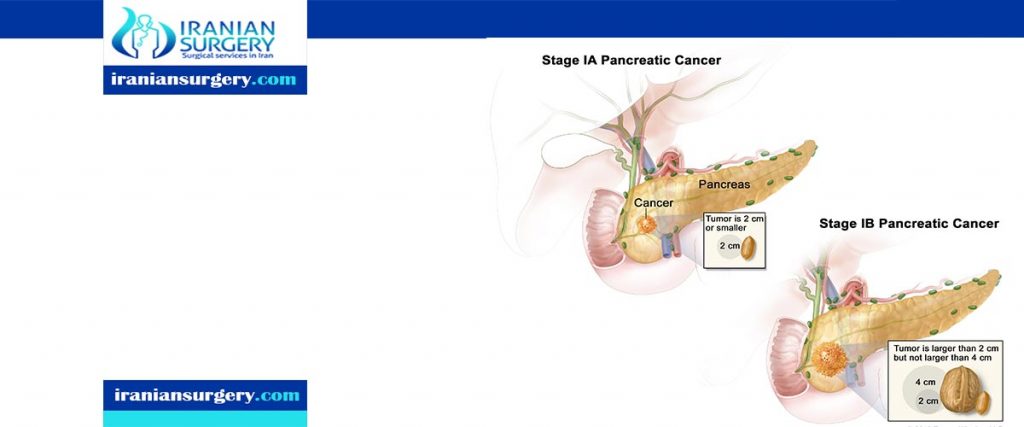 Pancreatic Cancer Treatment in Iran