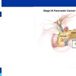 Pancreatic Cancer Treatment in Iran