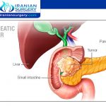 علاج سرطان البنكرياس في ايران