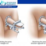 Penile Curvature Deformity