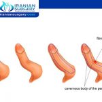 Penile curvature surgery