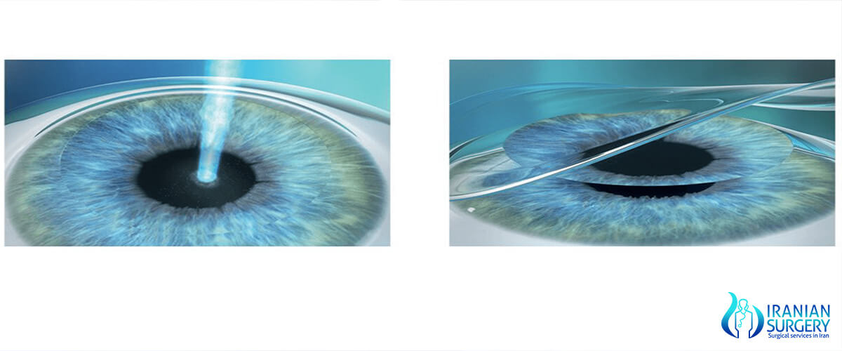 Photorefractive keratectomy(PRK)