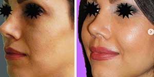 plastic surgery in iran