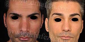 plastic surgery in iran
