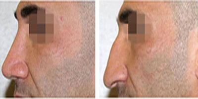 B&A rhinoplasty in iran