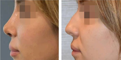 B&A rhinoplasty in iran
