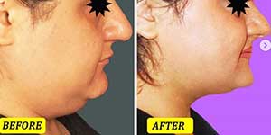 plastic surgery in iran