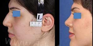 plastic surgery in iran