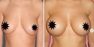 plastic surgery in iran