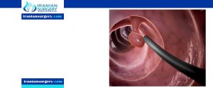 Polypectomy in Iran