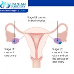 اعراض سرطان المبیض الاولیة