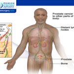 Prostate Cancer Stage 4