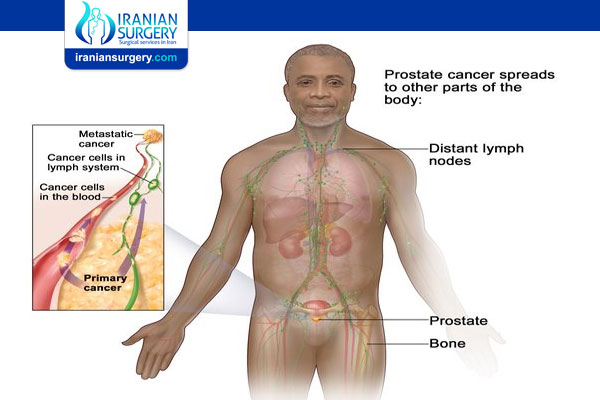 Prostate Cancer Stage 4