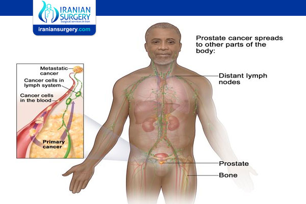 cancer de prostata stage 4