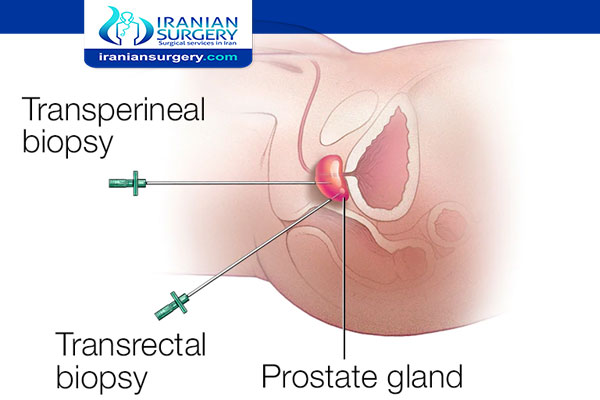 Prostate biopsy Procedure