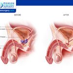 Recovery after Prostatectomy