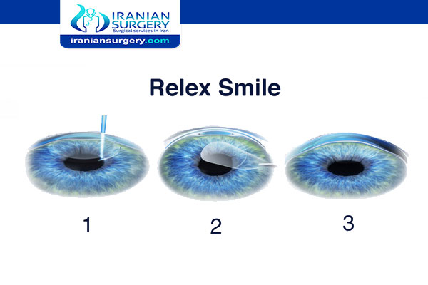 Relex Smile in Iran