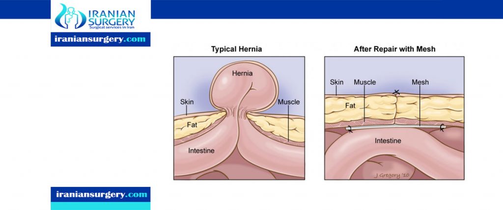 Repairing an umbilical hernia