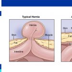 Repairing an umbilical hernia